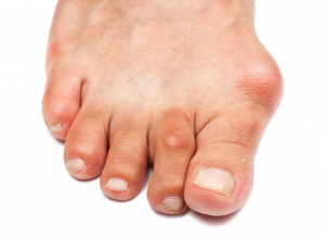 Hallux Valgus