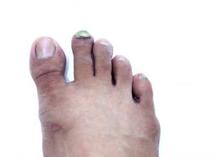 Psoriasis Fußnägel